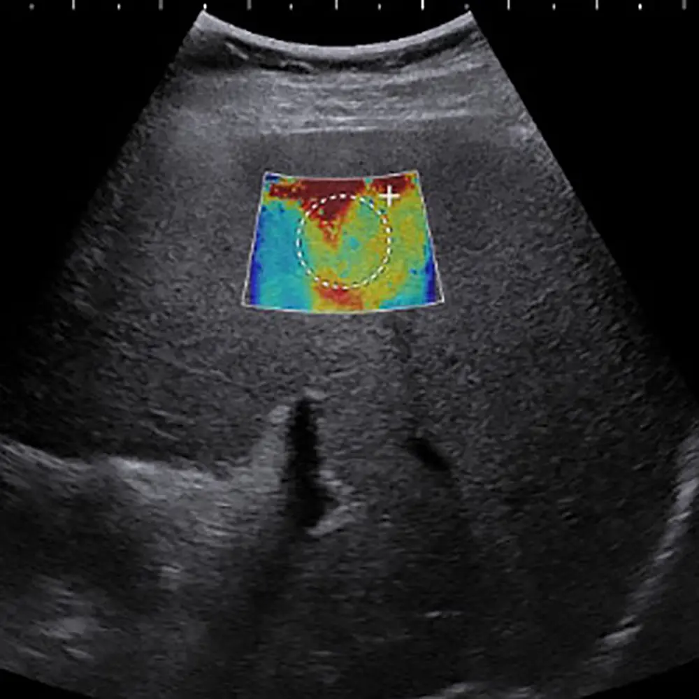 سیستم Liver Fibrosis Assessment