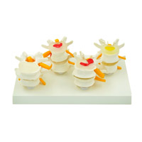 مولاژ مراحل دژنراسیون دیسک