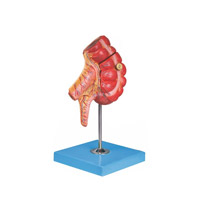 مولاژ آپاندیس