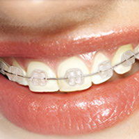 براکت رزینی شفاف