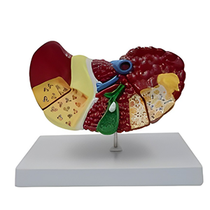 مولاژ بیماری های کبد