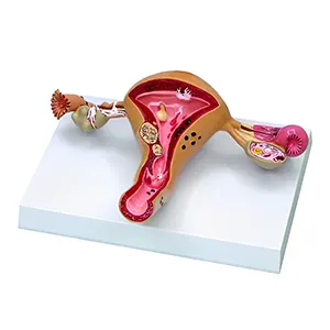 مولاژ بیماری های رحم