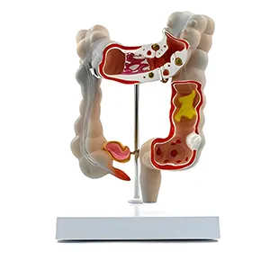 مولاژ روده بزرگ