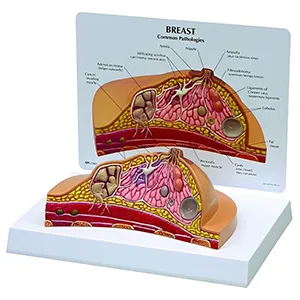 مولاژ پاتولوژی پستان