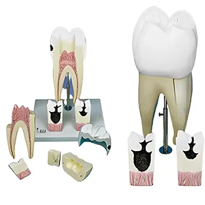 مولاژ اولین دندان آسیاب بزرگ فک تحتانی