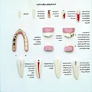 مولاژ دندان های سالم و پوسیده